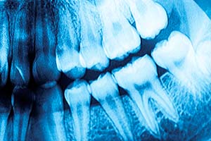 Дефицит Д обнаружат с помощью рентгена зубов